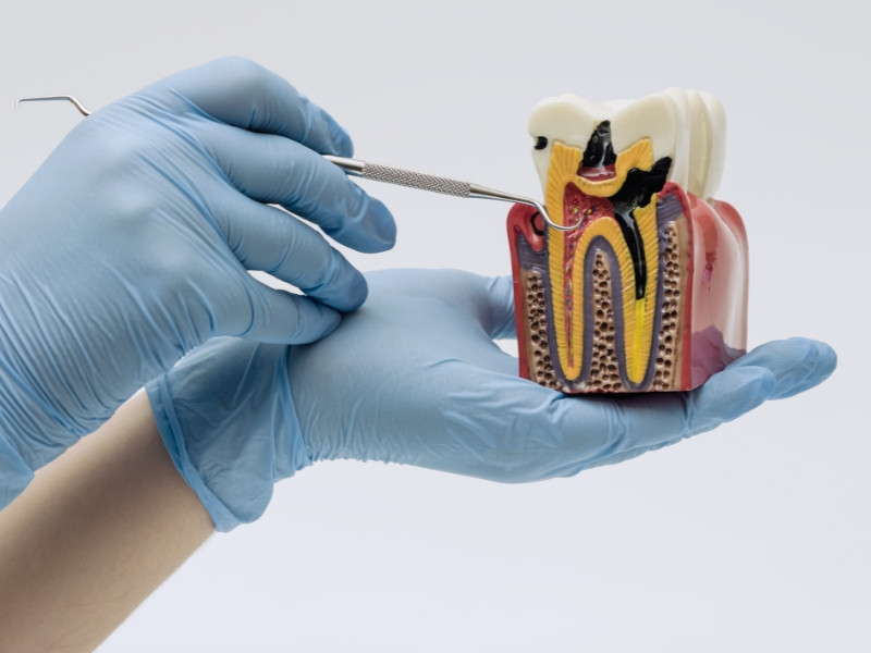 Ilustração clínica de desvitalização com modelo anatómico dentário e instrumento endodôntico