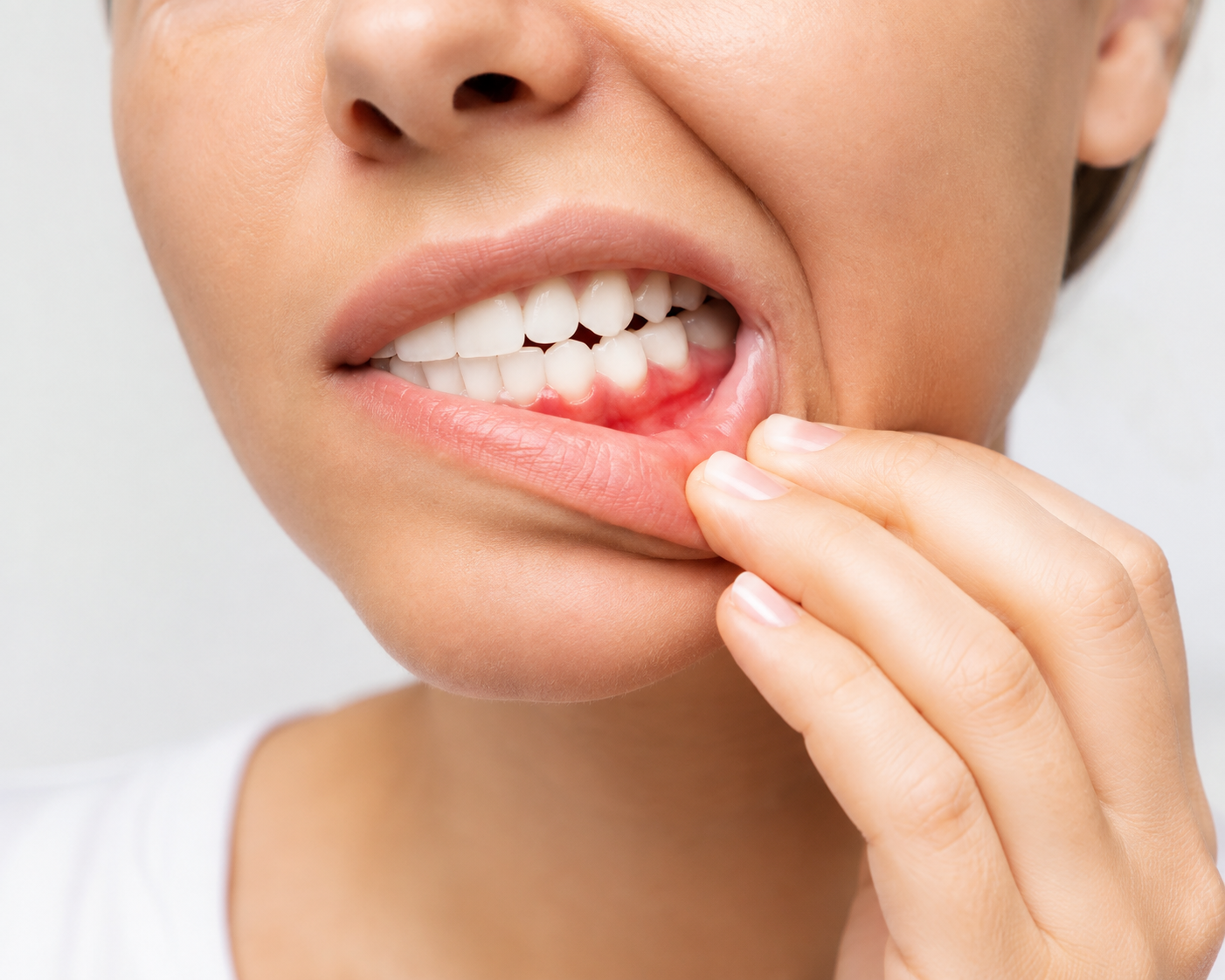 Close-up clínico de gengiva inflamada com sangramento, ilustrando um sinal periodontal